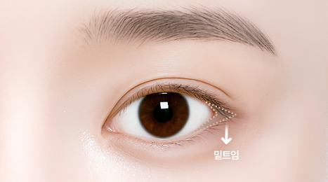 리트머스성형외과 수술방법 이미지