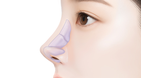 리트머스 구축코 수술방법 이미지