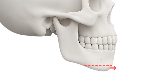 리트머스성형외과 수술방법 이미지