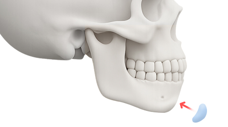 리트머스성형외과 수술방법 이미지