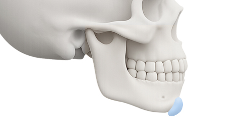 리트머스성형외과 수술방법 이미지