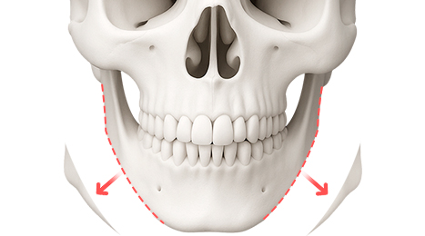 리트머스성형외과 수술방법 이미지