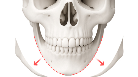 리트머스성형외과 수술방법 이미지
