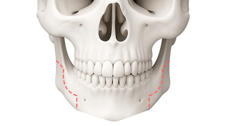 리트머스성형외과 수술방법 이미지