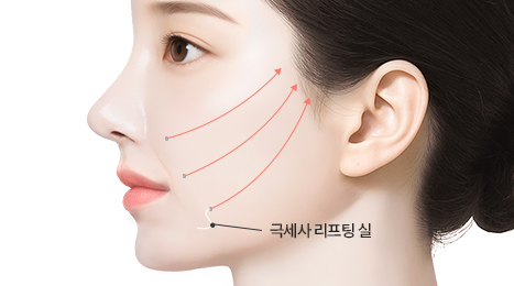 리트머스성형외과 수술방법 이미지