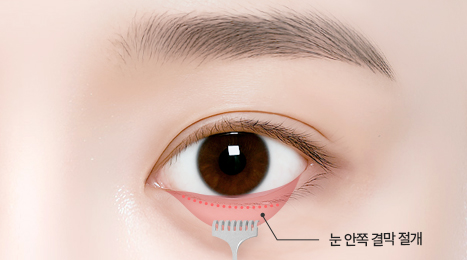 리트머스성형외과 수술방법 이미지