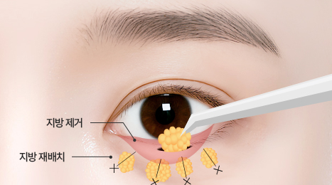 리트머스성형외과 수술방법 이미지