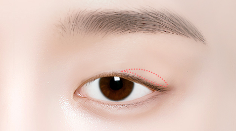 리트머스성형외과 상안검 수술방법 이미지