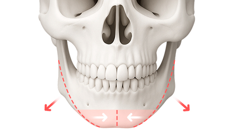 리트머스성형외과 수술방법 이미지