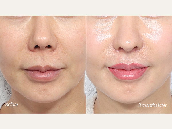 인중축소 + 코재수술 3개월차