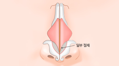 리트머스 화살코 수술방법 이미지