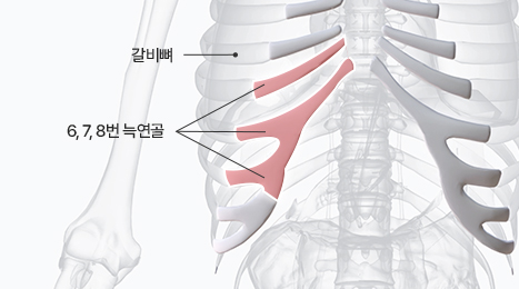리트머스 자가늑연골 이미지