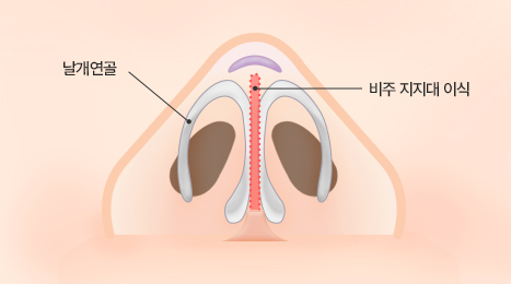 리트머스 자가연골 수술 방법 이미지