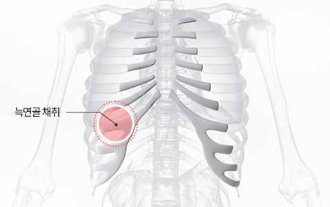 리트머스 자가늑연골 이미지