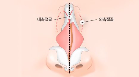 리트머스 휜코 수술 방법 이미지