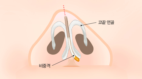 리트머스 비중격연골 휜코 수술 방법 이미지
