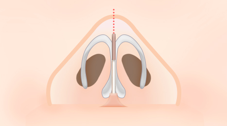 리트머스 비중격연골 휜코 수술 방법 이미지