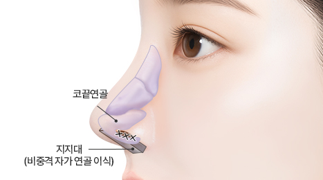 리트머스 구축코 수술방법 이미지