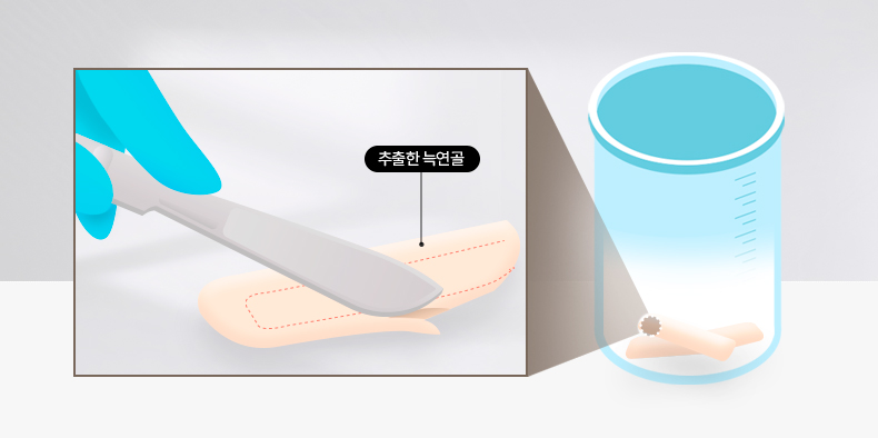 리트머스 성형외과 카빙 이미지