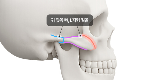 리트머스성형외과 수술방법 이미지