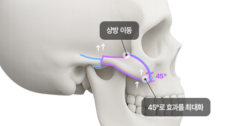 리트머스성형외과 수술방법 이미지