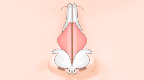 리트머스성형외과 복코 수술 이미지