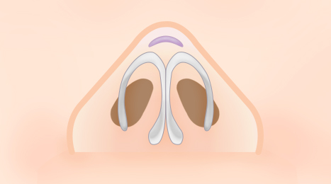 리트머스성형외과 복코 수술 이미지