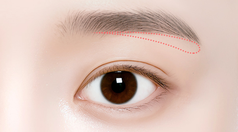 리트머스성형외과 눈썹거상 수술방법 이미지