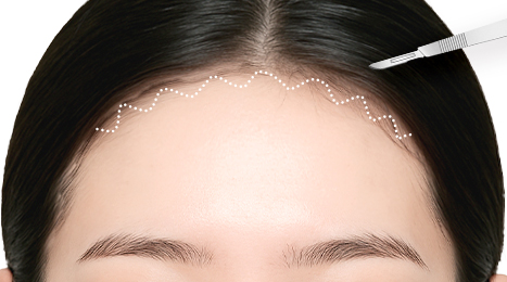 리트머스성형외과 수술방법 이미지