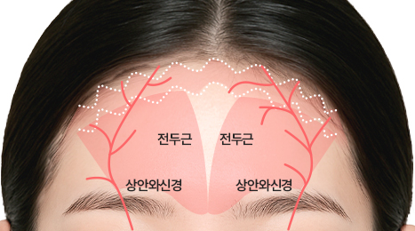 리트머스성형외과 수술방법 이미지