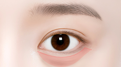 리트머스성형외과 수술방법 이미지