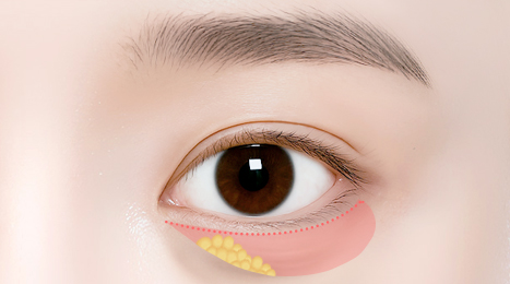 리트머스성형외과 수술방법 이미지