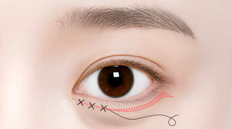 리트머스성형외과 수술방법 이미지