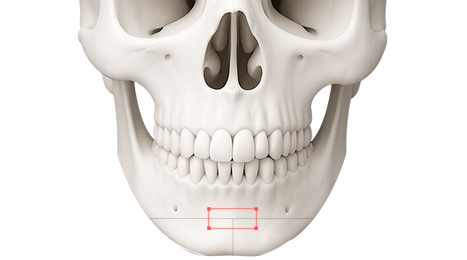 리트머스성형외과 수술방법 이미지