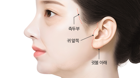 리트머스성형외과 미니거상 수술방법 이미지