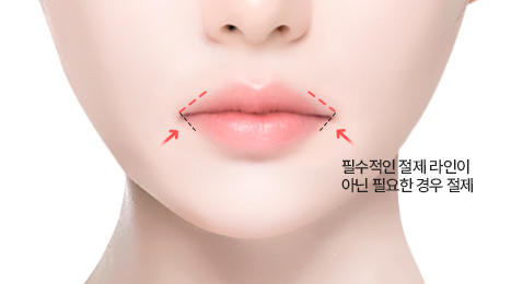 리트머스 외측입꼬리 수술방법 이미지