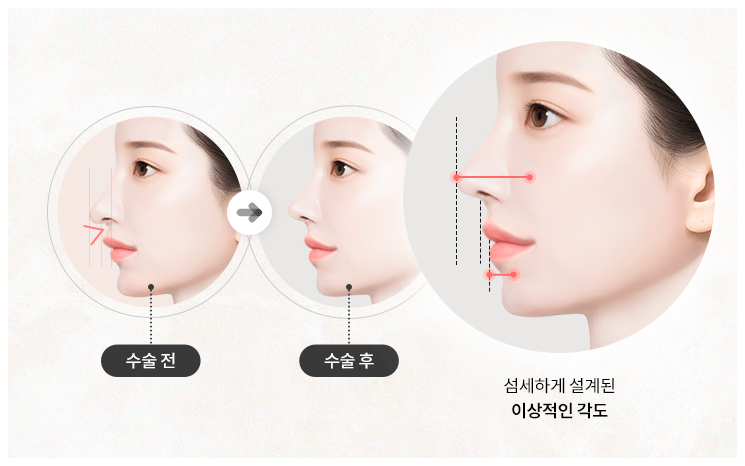리트머스성형외과 인중코의 특별함 설명 이미지