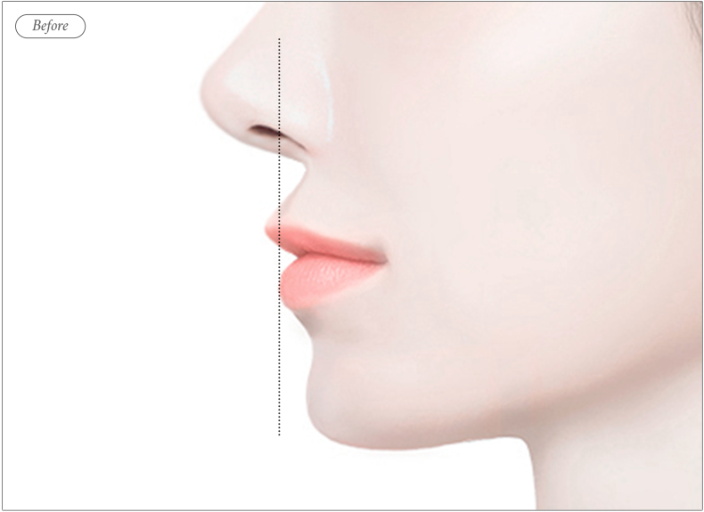 리트머스성형외과 비순각 교정술 전 일러스트 이미지