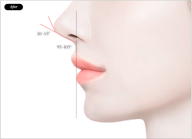 리트머스성형외과 비순각 교정술 후 일러스트 이미지