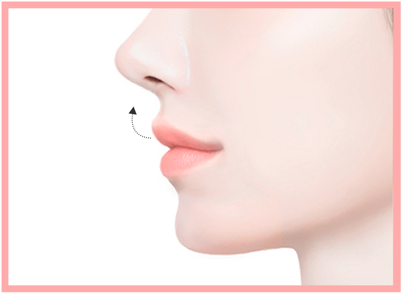 리트머스성형외과 비순각 교정술 후 일러스트 이미지