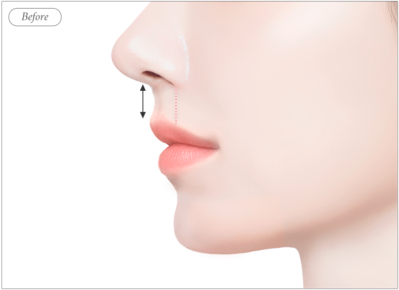 리트머스성형외과 인중축소 c컬 전 일러스트 이미지