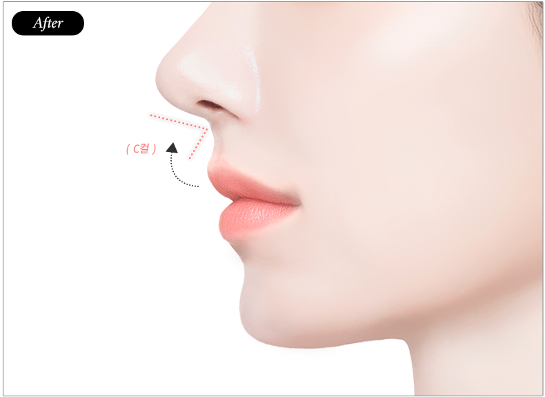 리트머스성형외과 인중축소 c컬 후 일러스트 이미지