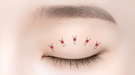 리트머스성형외과 수술방법 이미지