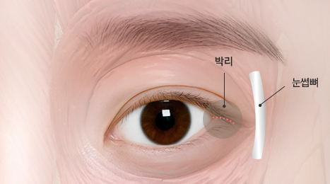 리트머스성형외과 수술방법 이미지
