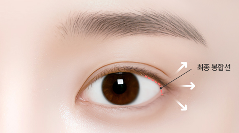 리트머스성형외과 수술방법 이미지