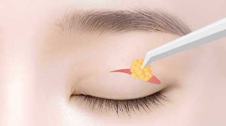 리트머스성형외과 상안검 수술방법 이미지