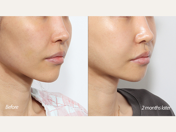 genioplasty and zygoma surgery (chin reduction and cheekbone reduction)