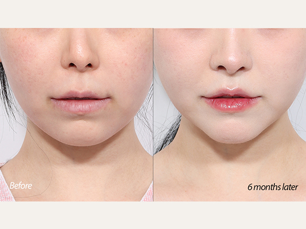 Facial contouring for cheeckbone reduction, sqaure jaw reduction, and chin reduction.