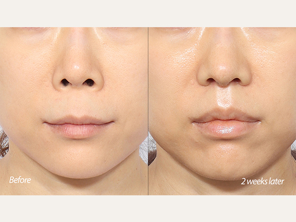 2da semana de reducción del surco nasolabial + rinoplastia