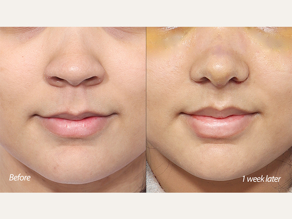 levantamiento de labios y rinoplastia